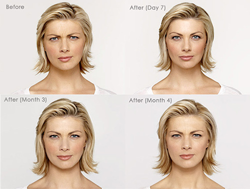 botox