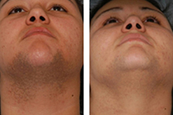 laser hair removal before and after